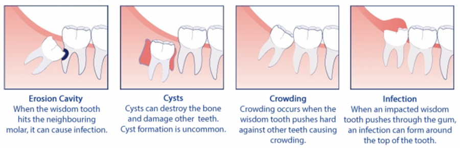 The Problems Wisdom Teeth Cause 1024X329